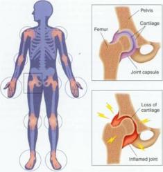 arthritis, osteoarthritis,